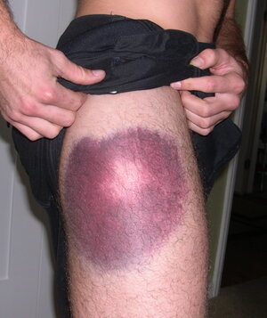 hematoma3.jpg