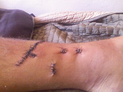 tib fib 2.jpg