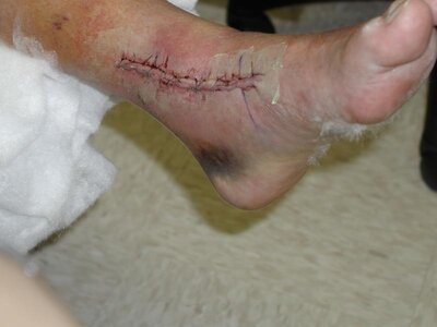 stitches left side.jpg