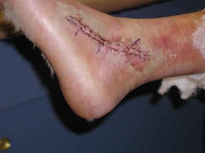 stitches right side.jpg