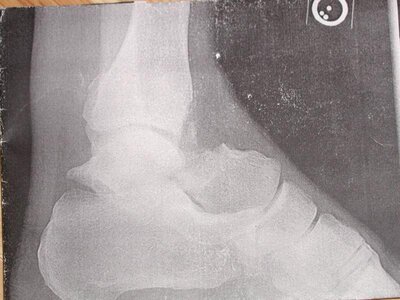 ankle.jpg