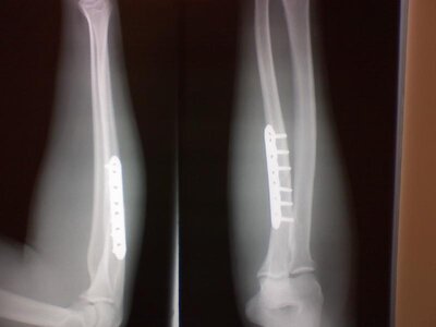 arm xray.jpg