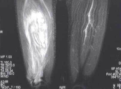 Mike MRI cropped.jpg