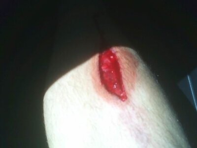 the cut that showed the bone1.jpg