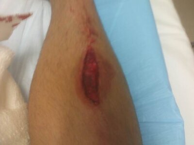 the cut that showed the bone 3.jpg