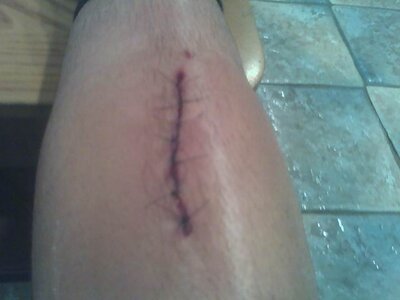 the cut that showed the bone Stitched up.jpg