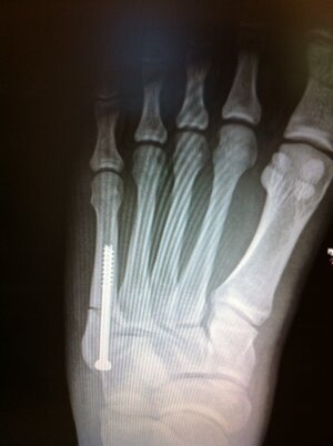 Broken foot 1.JPG Broken foot 1.JPG