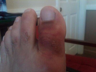 Broken Toe.jpg